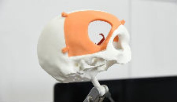 Esta es una muestra de la impresión 3D para una craneoplastía, creada en el Neurolab 3D